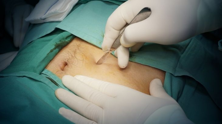 Cerrahi kesi yerine kasıktan damar yoluyla uygulanan EVAR yöntemi, anevrizma patlamasını önlemek amacıyla daraltılmış bölgeye özel bir kaplama yerleştirilerek gerçekleştirilir.