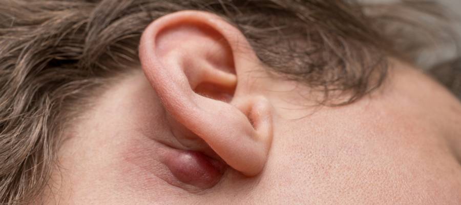 Kulak arkasında ortaya çıkan şişlik bazen sadece basit bir kist olabilir, bazen de vücudun savunma tepkisinin yansımasıdır.