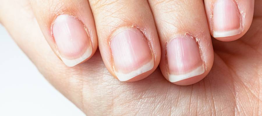 Tırnak eti koparma alışkanlığı şeytan tırnağına sebep olabilir.