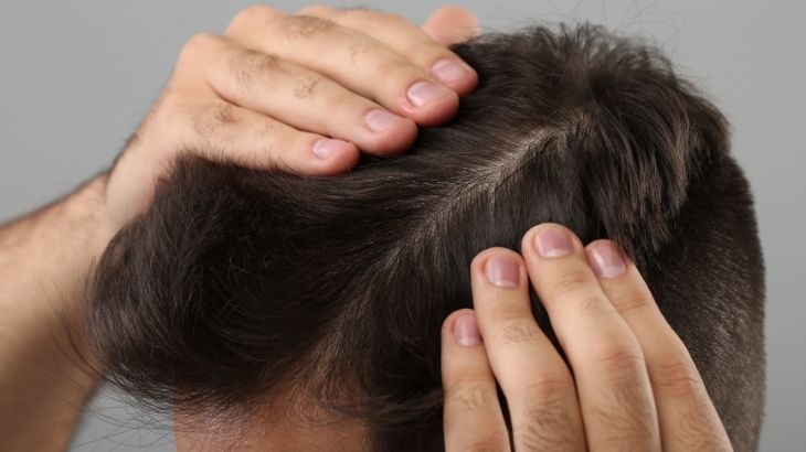 Saç mantarı tedavisinde birçok yöntemden yararlanmak mümkündür.