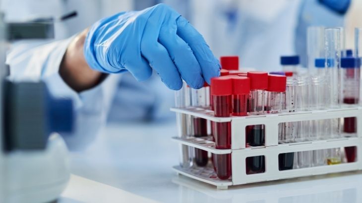 İşlem sırasında hastadan alınan kan örneği laboratuvarda incelenir ve CEA düzeyi özel cihazlarla belirlenir.