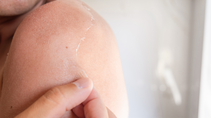 Cildin uzun süre güneşe maruz kalması cilt soyulması gibi durumlara yol açabilir.