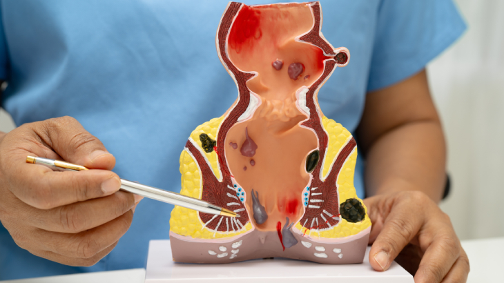 hemoroid nasıl geçer