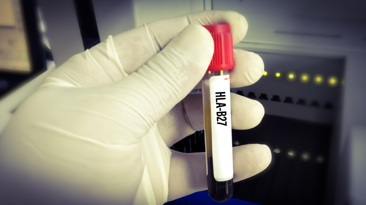 HLA B27 testi için aç kalmaya gerek olmadan kan verilebilir.