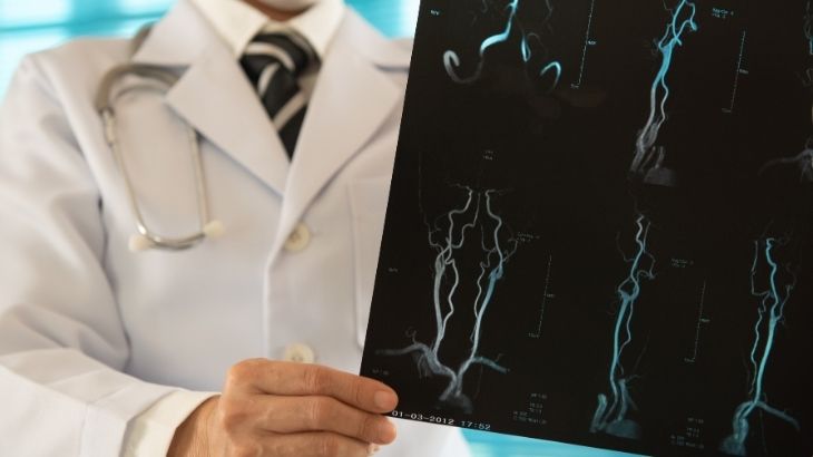 Beyin anjiyosunun çeşidine doktor semptomlara göre karar verebilir.