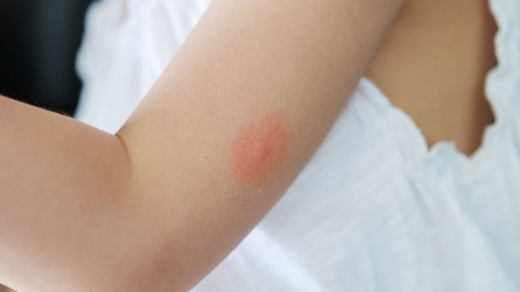 Isırıkta ilk belirti&nbsp;Kızarıklık ve hafif kabarıklık olur.
