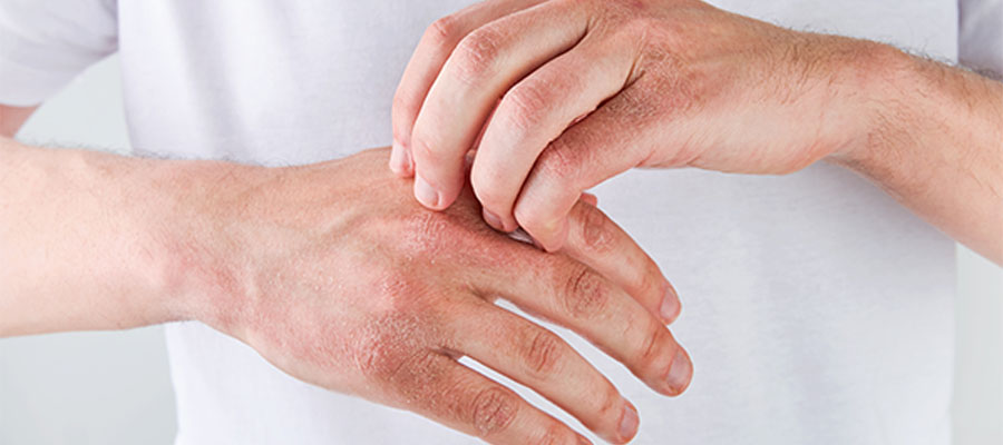 Hastalıkta cilt komplikasyonları görülebilir, bu sebeple erken müdahale önemlidir.