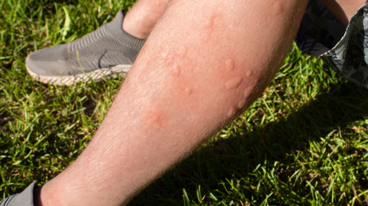 sivrisinek ısırığı