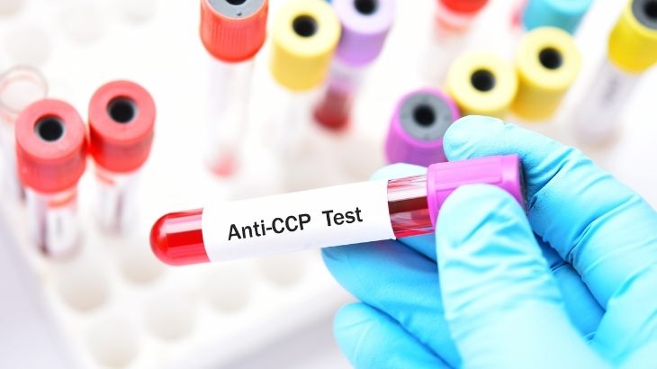 Anti-CCP testi genellikle koldan kan alınarak yapılır.