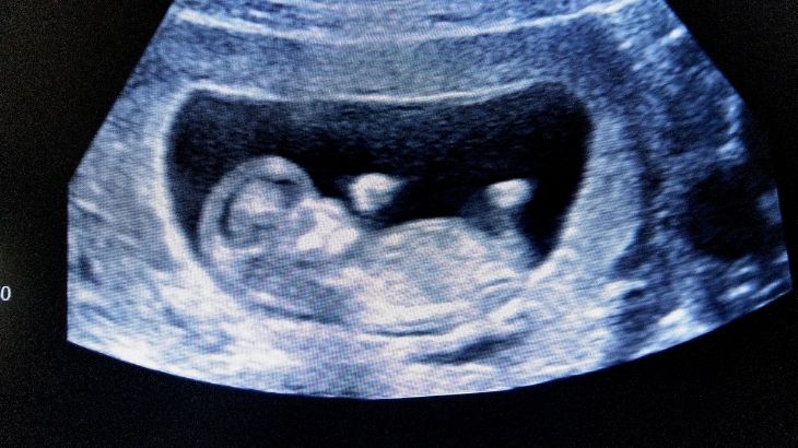 11 haftalık bebek ultrason görüntüsü