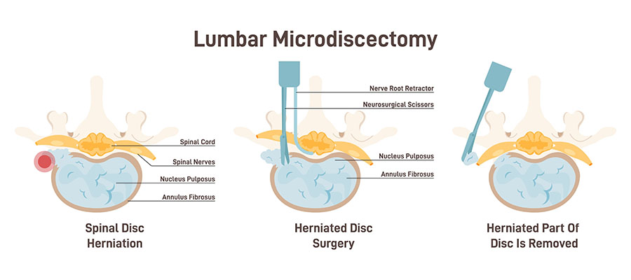 Lomber mikrodiskektomi sürecini gösteren illüstrasyon: solda bel fıtığı ile sinir kökü basısı, ortada cerrahi müdahale, sağda çıkarılmış disk parçası sonrası omurga yapısı.
