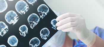 ALS hafızayı ve zihni etkilemez!