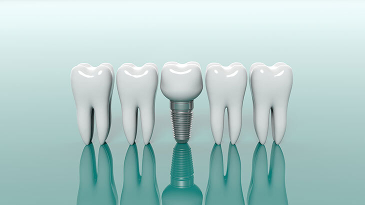 Diş eksikliklerinde implant tedavisi