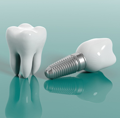Diş implantı ve protezi yaptırmadan önce bunları okuyun!