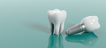 Diş eksikliklerinde implant tedavisi