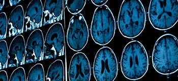 Felç belirtilerini gözden kaçırmayın