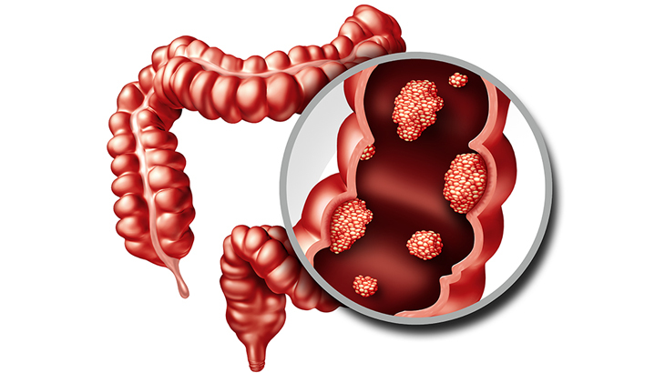 Kolon kanserinden korunma yolları