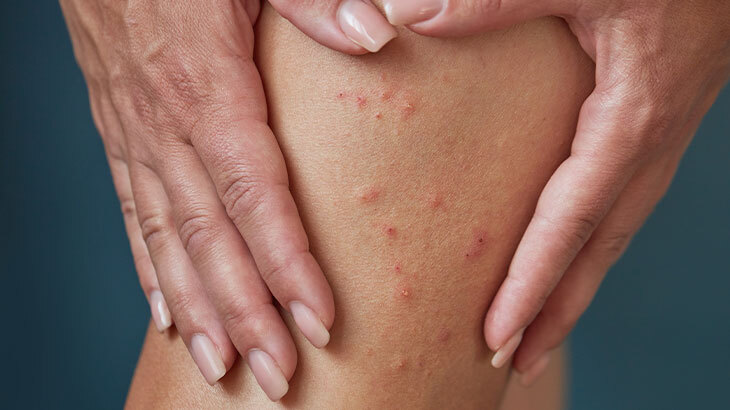 Pire Isırığı Nedir?  Pire Isırığı Nasıl Geçer?