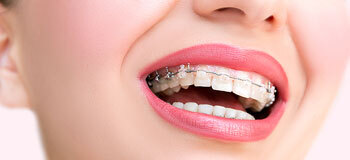 Çocuklarda erken diş kaybının 5 nedeni
